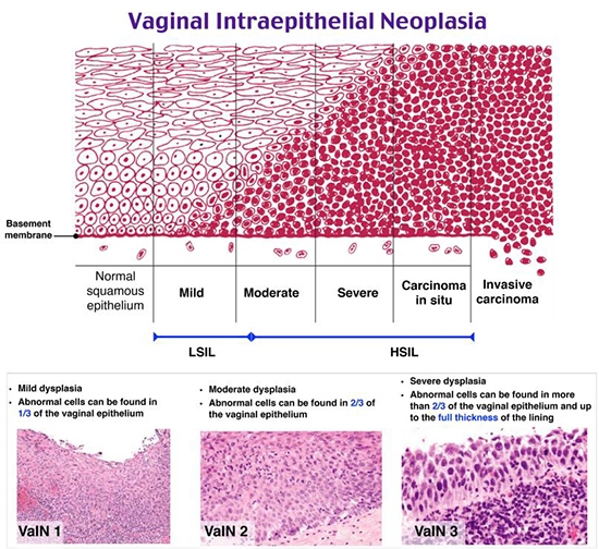 东方略治疗性HPV疫苗获批阴道癌前病变新适应症II期临床研究